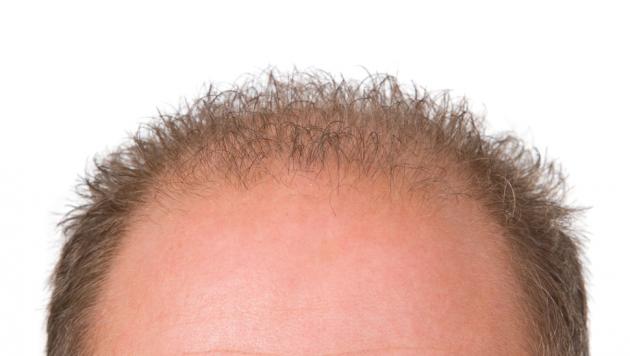 baldness1.jpg