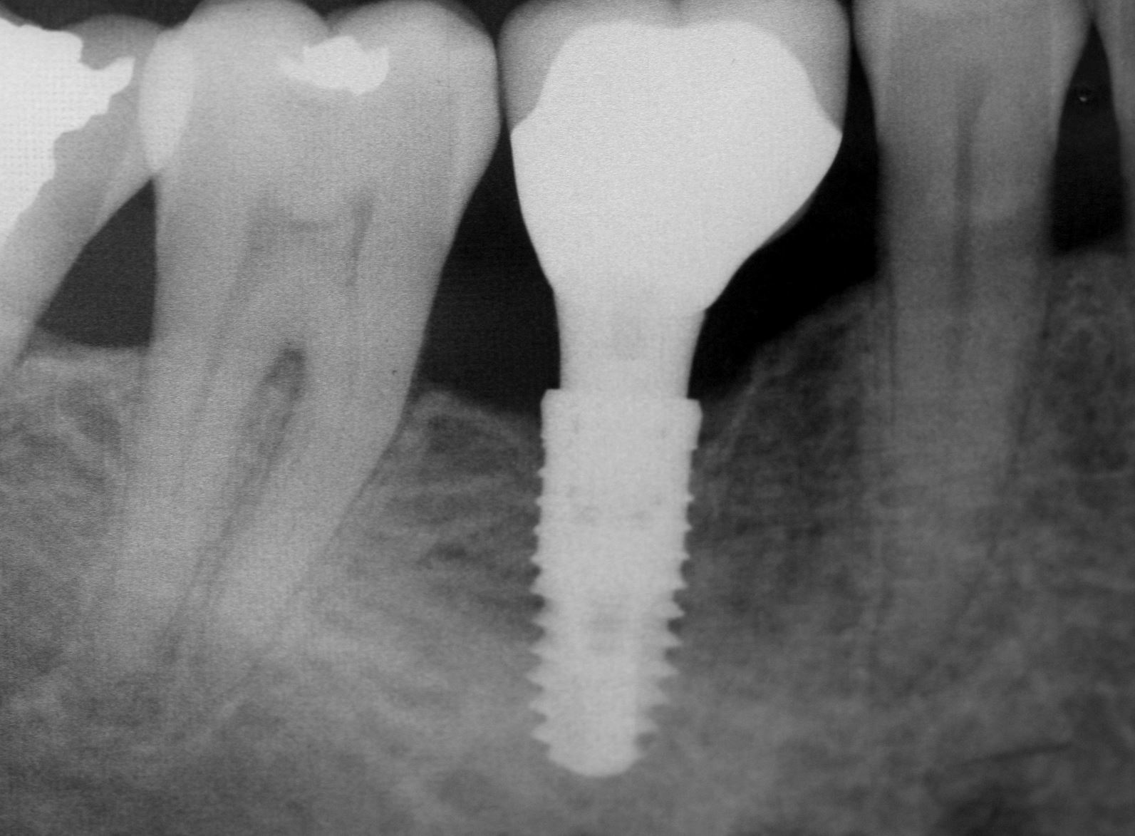dentures3.JPG