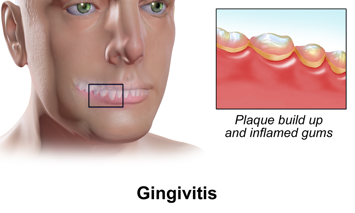 Gingivitis.png