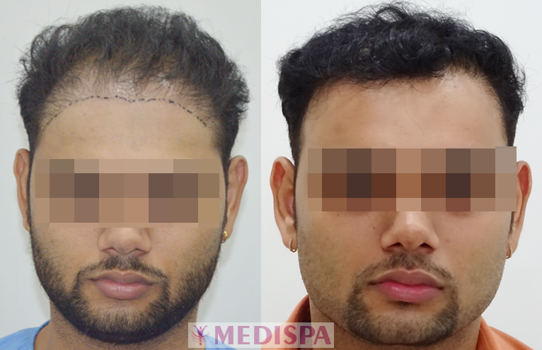 hair_transplant_results.png